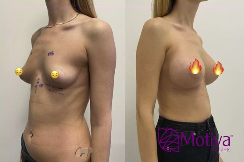 Фото - Перший досвід з новими імплантами Motiva. Відгук.