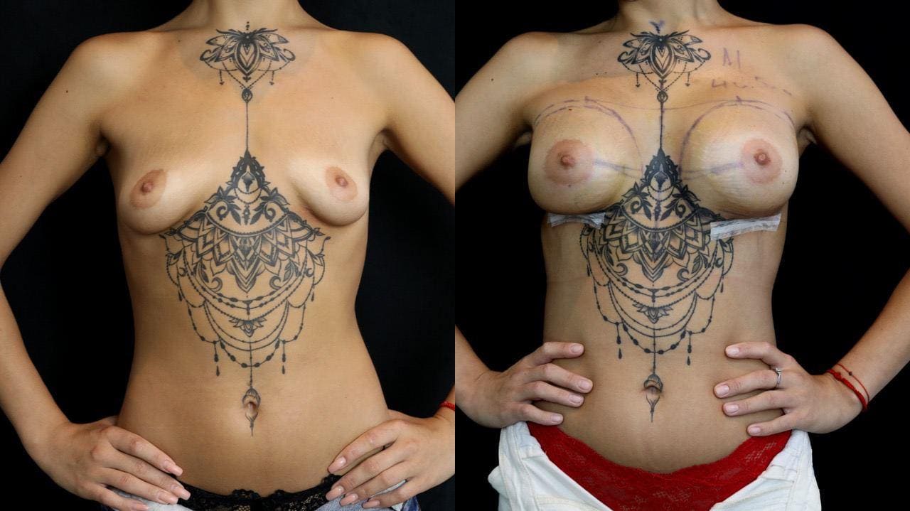 Фото - Доктор Андрій Леонідович Харьков : установка имплантатів Anatomical TrueFixation.