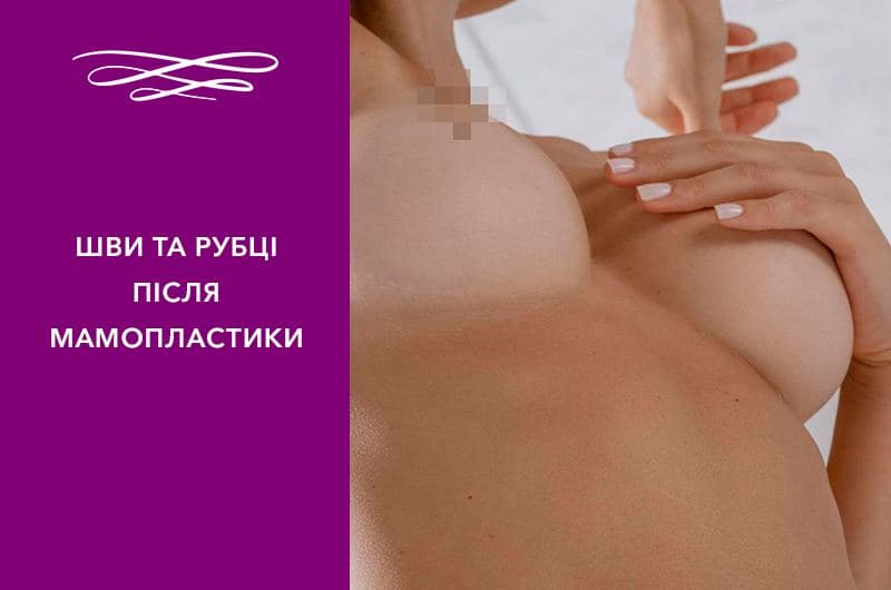 Шви та рубці після мамопластики