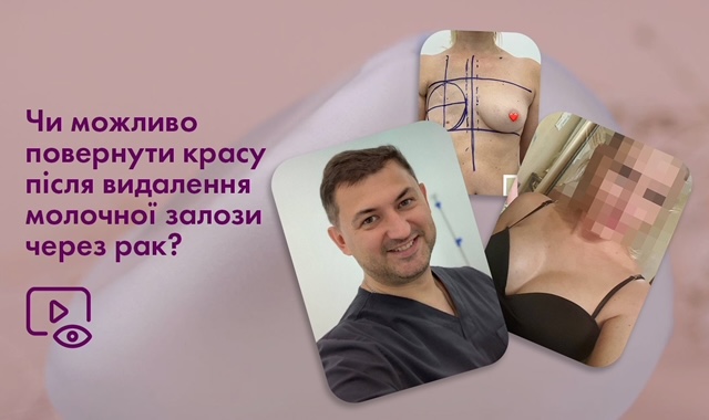 Поетапне відновлення молочної залози після її видалення з використанням імплантів Motiva Фото - Поетапне відновлення молочної залози після її видалення з використанням імплантів Motiva